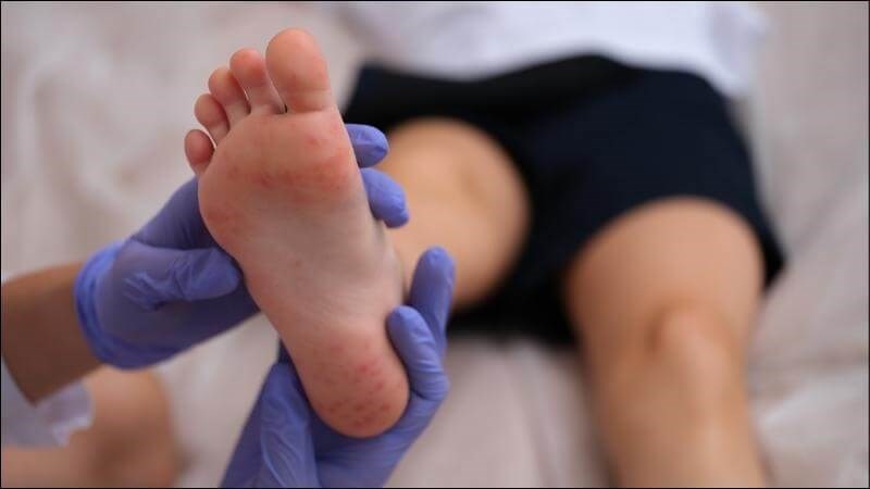 Tay chân miệng là bệnh nhiễm khuẩn cấp tính do các virus thuộc chi Enterovirus gây nên