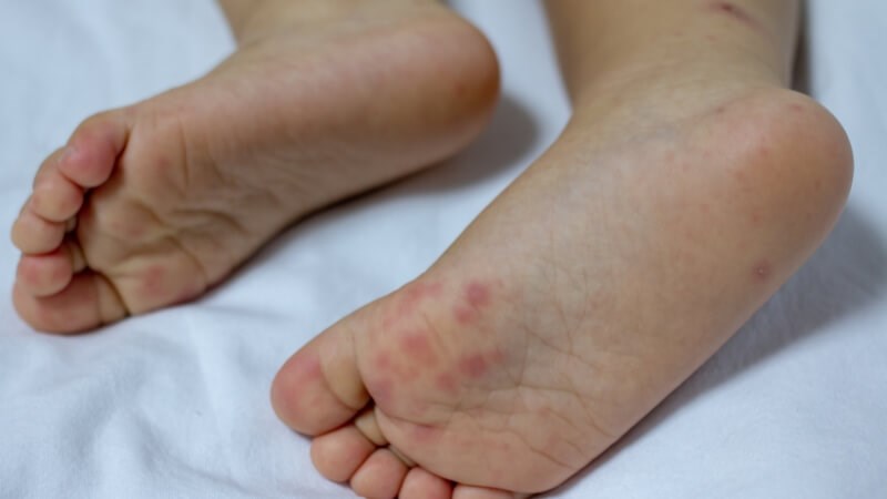 Sang thương tay chân miệng thường được tìm thấy ở lòng bàn tay, bàn chân, miệng,...