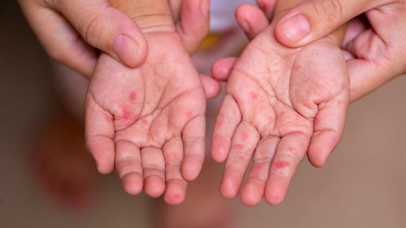 Biểu hiện của thuỷ đậu thường là mụn nước rốn lõm mọc thành chùm trên nền hồng ban