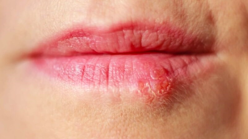 Biểu hiện của Herpes simplex là mụn nước mọc quanh các lỗ tự nhiên