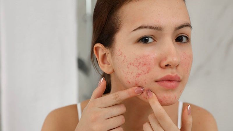 Mụn trứng cá là một vấn đề phổ biến mà nhiều người phải đối mặt