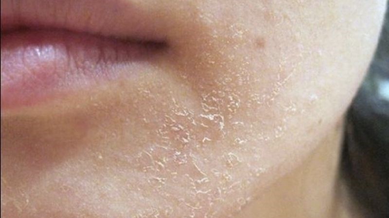 Khi thiếu độ ẩm, da của bạn có thể bị khô, từ đó có thể gây bong tróc