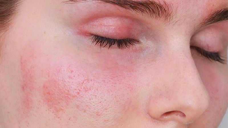  Da thường bị mẩn đỏ và ngứa ngáy do mất đi hàng rào bảo vệ da