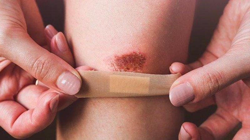 Chống làm lành vết thương là một trong những đặc tính của ba kích