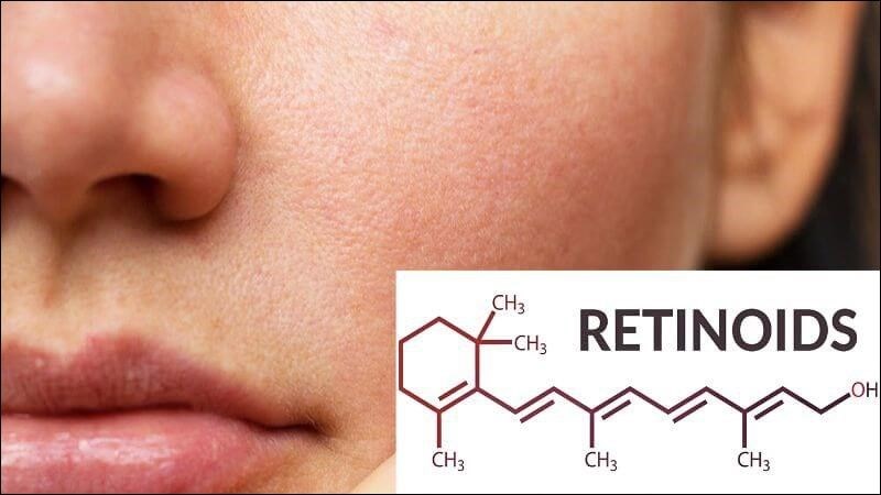 Retinoid giúp loại bỏ các tế bào da chết gây tắc nghẽn lỗ chân lông