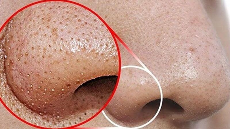 Những người có làn da dầu thường xuyên nổi mụn đầu đen 