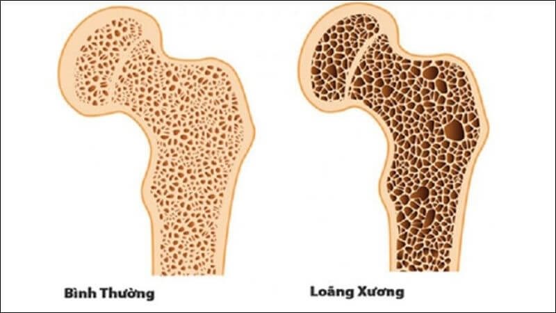 Vitamin E làm tăng nguy cơ loãng xương