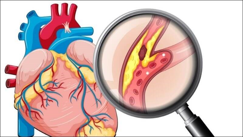 Dầu cá giúp giảm nguy cơ mắc các bệnh tim mạch