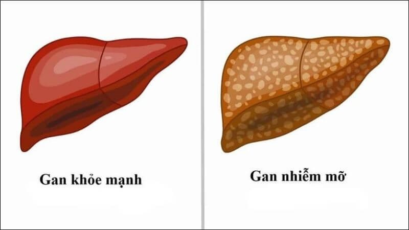 Dầu cá giúp giảm tình trạng gan nhiễm mỡ