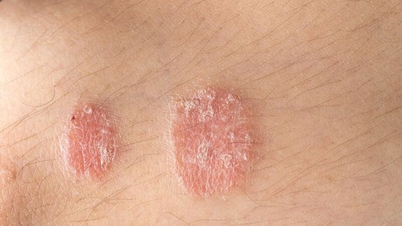 Dầu cá hỗ trợ điều trị bệnh vẩy nến