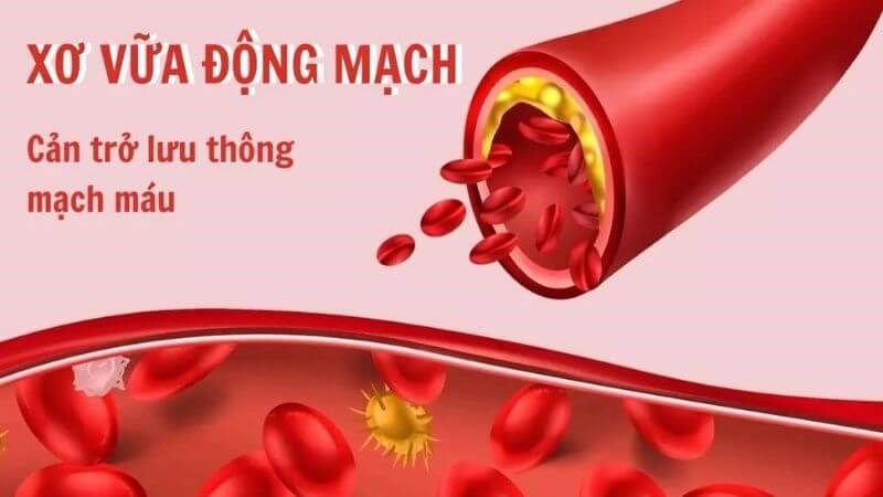 Dầu cá giúp ngăn ngừa xơ vữa động mạch