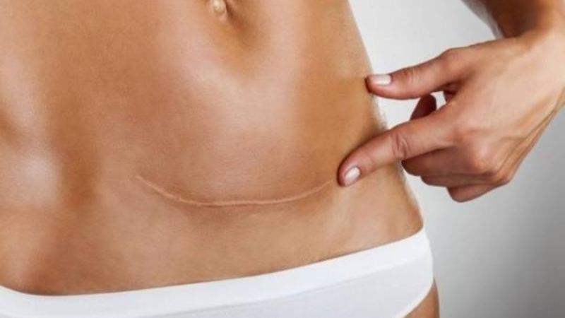 Phương pháp sinh mổ có thể ảnh hưởng đến quá trình sản xuất sữa của người mẹ 