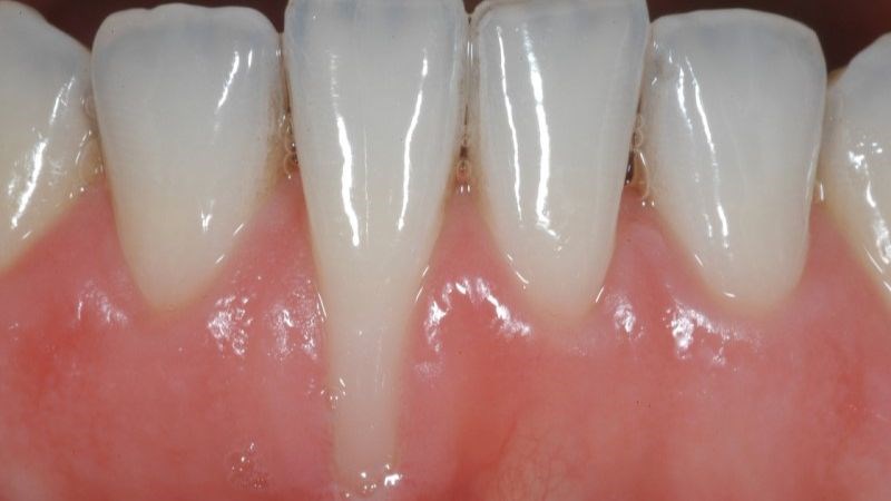 Tụt viền nước làm rộ chân răng khiến bạn dễ bị ê buốt răng