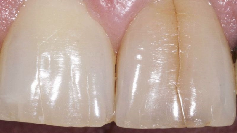 Răng bị nứt, vỡ có thể dẫn đến việc vi khuẩn xâm nhập vào lớp men bảo vệ, gây ê buốt