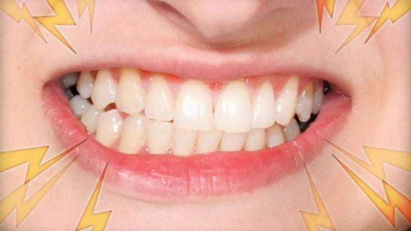 Thói quen nghiến răng quá mạnh, đặc biệt là vào ban đêm, có thể làm hư tổn men răng