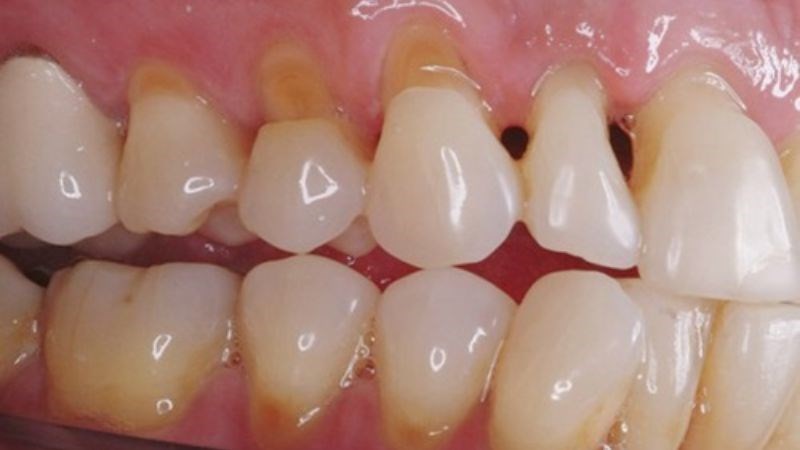 Răng ê buốt ảnh hưởng đến chất lượng cuộc sống hàng ngày