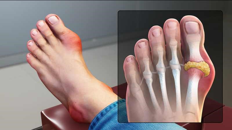 Những người mắc bệnh gout không nên ăn cá lóc