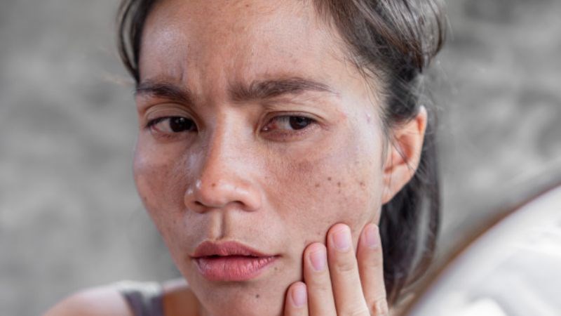 Nhiễm chì gây nên những ảnh hưởng nghiêm trọng đến làn da Nhiễm chì gây nên những ảnh hưởng nghiêm trọng đến làn da