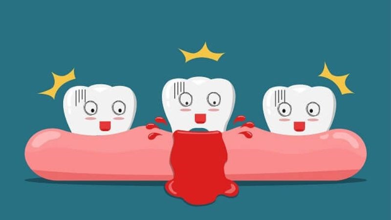 Paracetamol kết hợp với thuốc chống đông máu có thể gây chảy máu chân răng