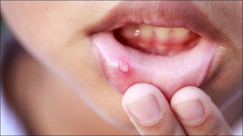 Paracetamol có thể gây ra các vết loét miệng
