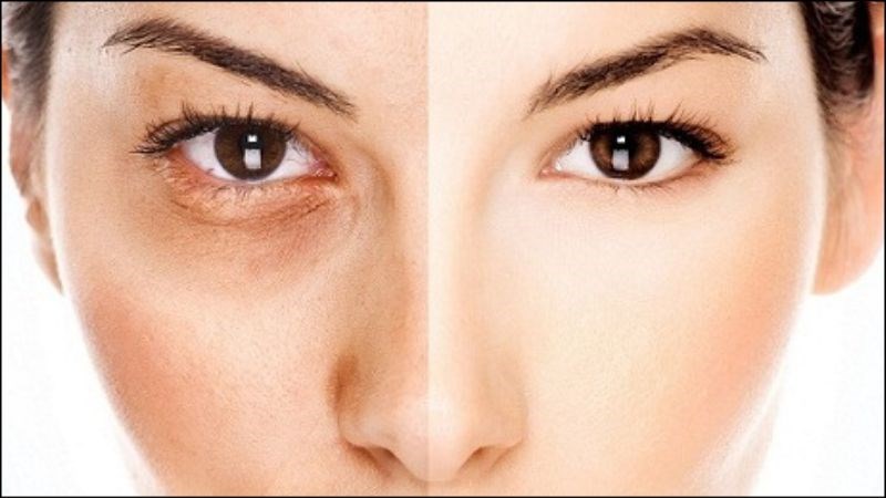 Nên bôi kem chống nắng vùng mắt cẩn trọng, vì đây là vùng da dễ bị tổn thương