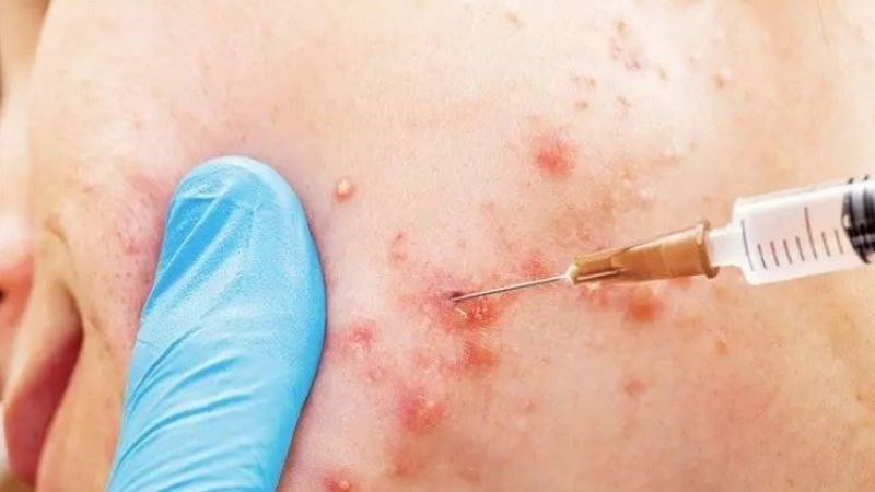 Tiêm Cortisone là một trong những phương pháp điều trị khẩn cấp giúp giải quyết mụn ẩn
