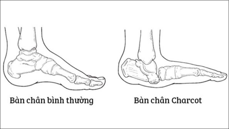 Bàn chân Charcot là một trong các biến dạng bàn chân ở người tiểu đường