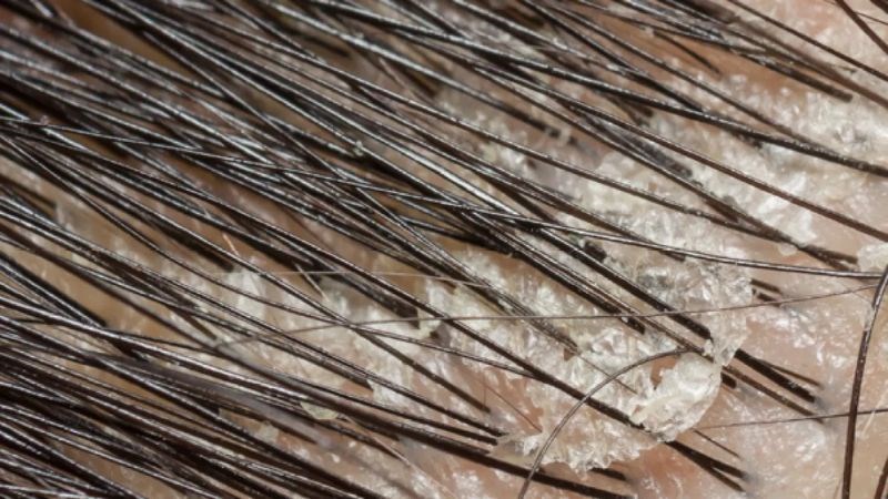 Tuyến bã nhờn tiết nhiều dầu dẫn đến tích tụ mảng bám gàu, bụi bẩn,... Tuyến bã nhờn tiết nhiều dầu dẫn đến tích tụ mảng bám gàu, bụi bẩn,...