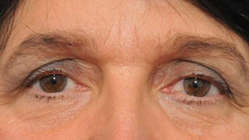 Tôm mang lại hiệu quả trong việc điều trị thoái hóa điểm vàng