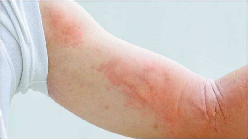 Ăn tôm có thể gây ra tình trạng nổi mề đay