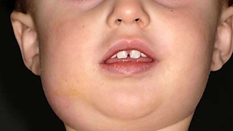 Có thể sử dụng ngưu tất để chữa trị bệnh quai bị