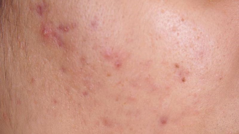 Peel da sẽ hỗ trợ làm mờ các vết sẹo do mụn