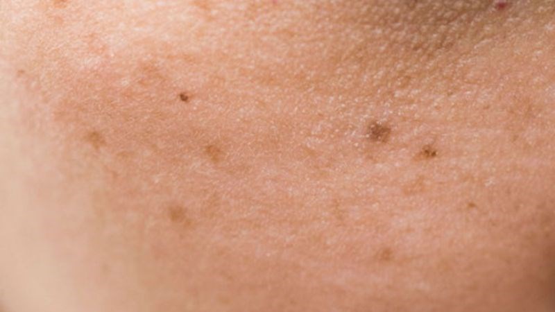 Peel da sẽ tái tạo và phục hồi tế bào da, giảm các vết thâm, đốm và tàn nhang