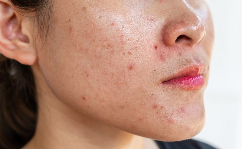 Peel da cho hiệu quả trên nhiều đối tượng khác nhau, đặc biệt là da dầu mụn