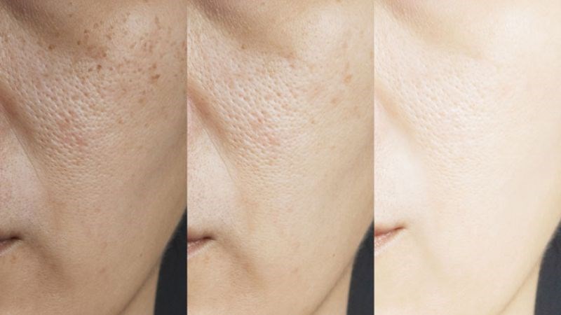 Peel da cho hiệu quả rõ ràng trong việc làm thu nhỏ lỗ chân lông