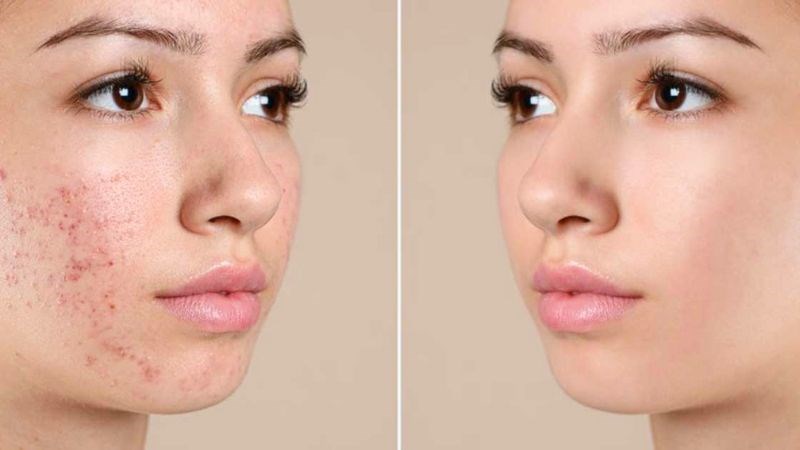 Peel da sẽ giúp làm sạch sâu, giảm tình trạng mụn viêm nhiễm