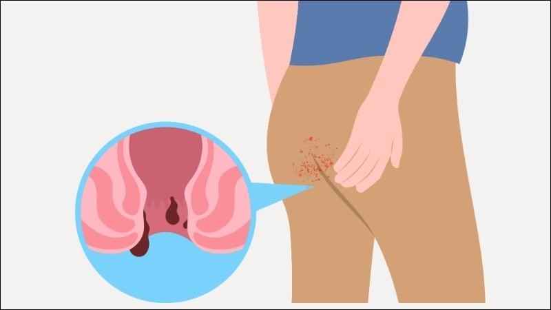 Nứt kẽ hậu môn có thể gây biến chứng thiếu máu mạn do chảy máu kéo dài