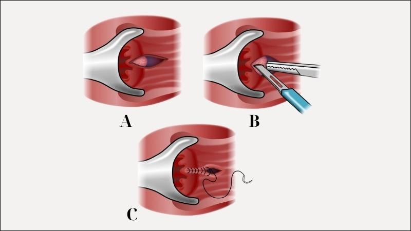 Phẫu thuật điều trị vết nứt kẽ hậu môn