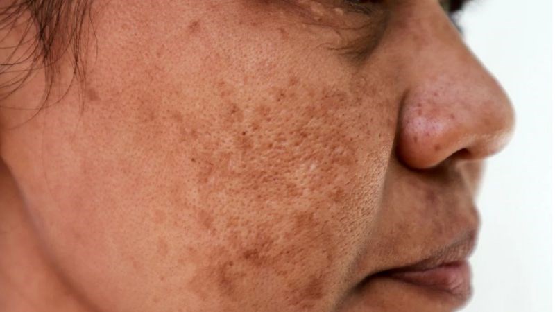 Tàn nhang là những vết sắc tố có màu đen hoặc nâu trên da