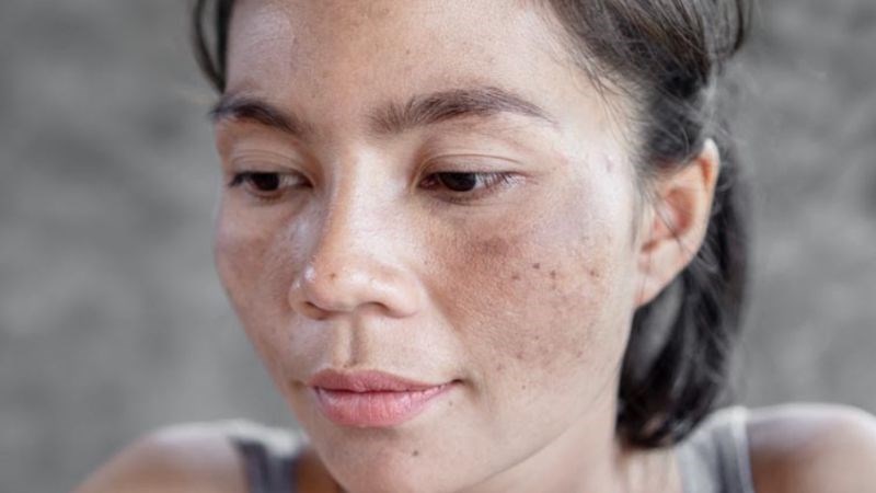 Có rất nhiều nguyên nhân gây nên tình trạng tàn nhang