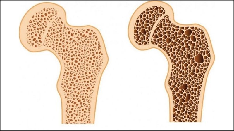 Chức năng thận hư nên không thể xử lý vitamin, khoáng chất giúp phát triển xương
