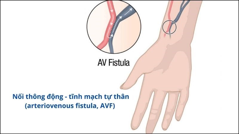 Cầu nối động tĩnh mạch tự thân ( AVF) là con đường lọc máu phổ biến nhất