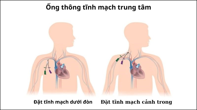Quy trình này được thực hiện ở bệnh nhân cần chạy thận khẩn cấp