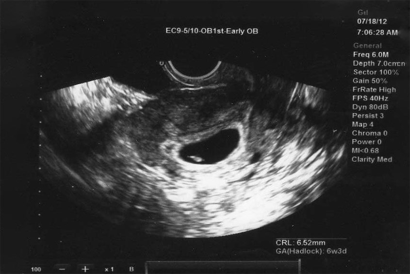 Hình ảnh siêu âm thai nhi 4 tuần tuổi