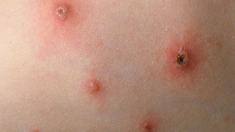 Giai đoạn hồi phục bệnh thủy đậu, mụn nước sẽ tự động vỡ v&agrave; kh&ocirc; lại