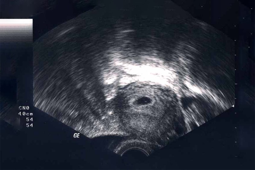 Hình ảnh siêu âm thai nhi 1 tuần tuổi Hình ảnh siêu âm thai nhi 1 tuần tuổi