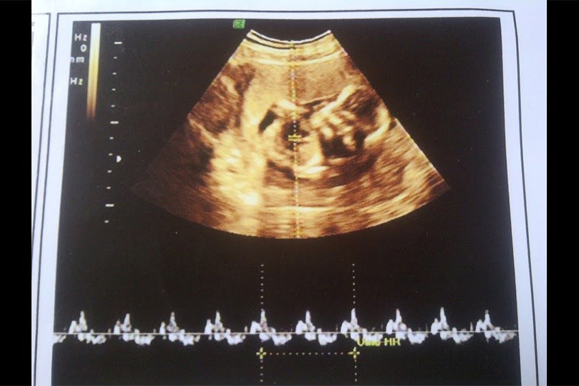 Hình ảnh siêu âm thai nhi 7 tuần tuổi