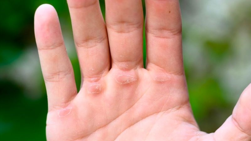 Sữa dưỡng thể có thể giúp làm mềm các vết chai trên da