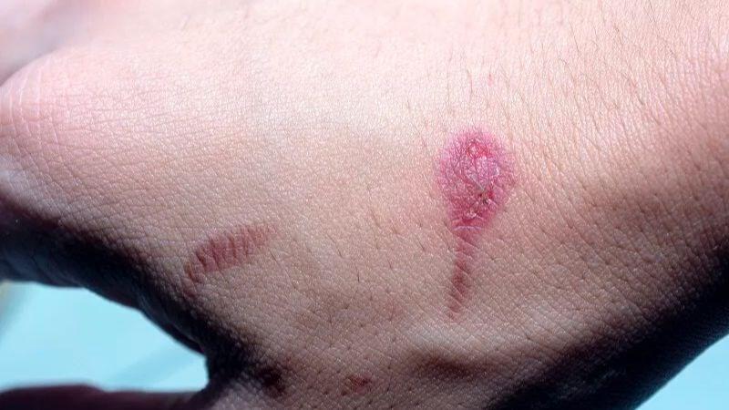 Sữa dưỡng thể có khả năng thúc đẩy quá trình làm lành sẹo