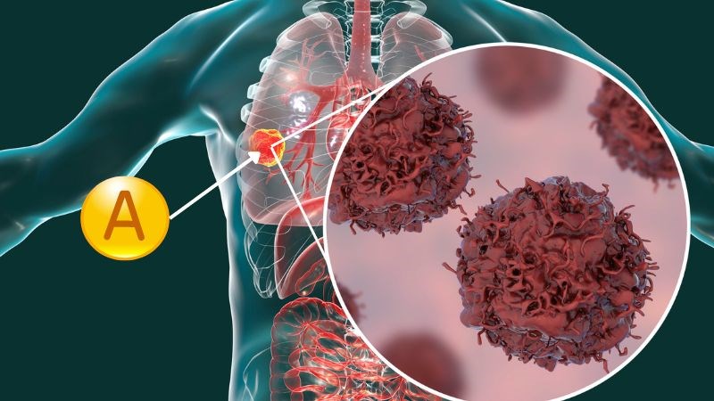 Vitamin A có thể hỗ trợ trong quá trình điều trị một số loại ung thư
